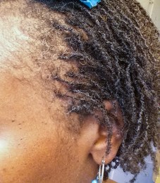 Hairline after 2nd Reti