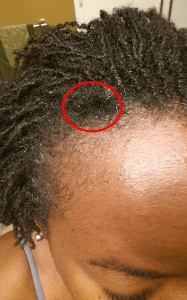 5-month slippage from wearing a hat.