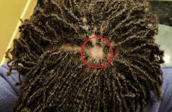 Lupus bald spot